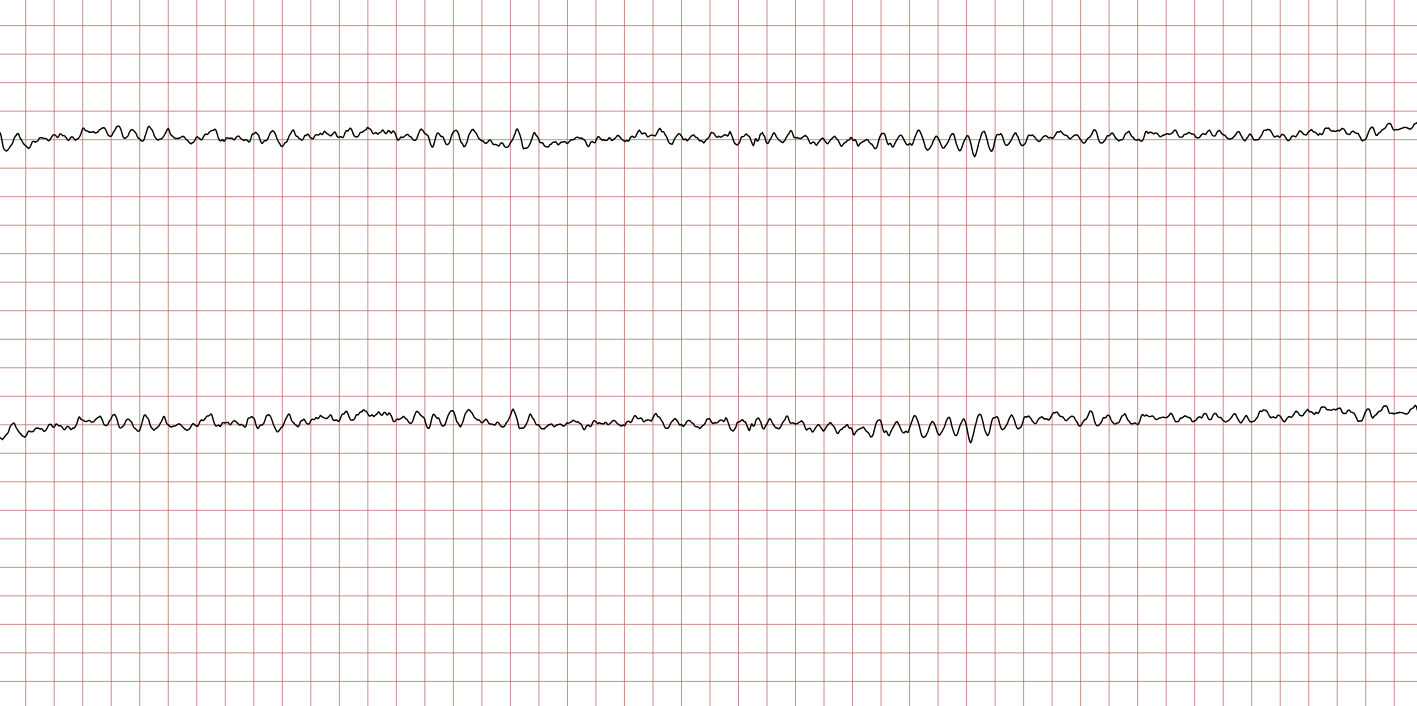 EKG 4 (Fall 2): fortbestehendes Kammerflimmern