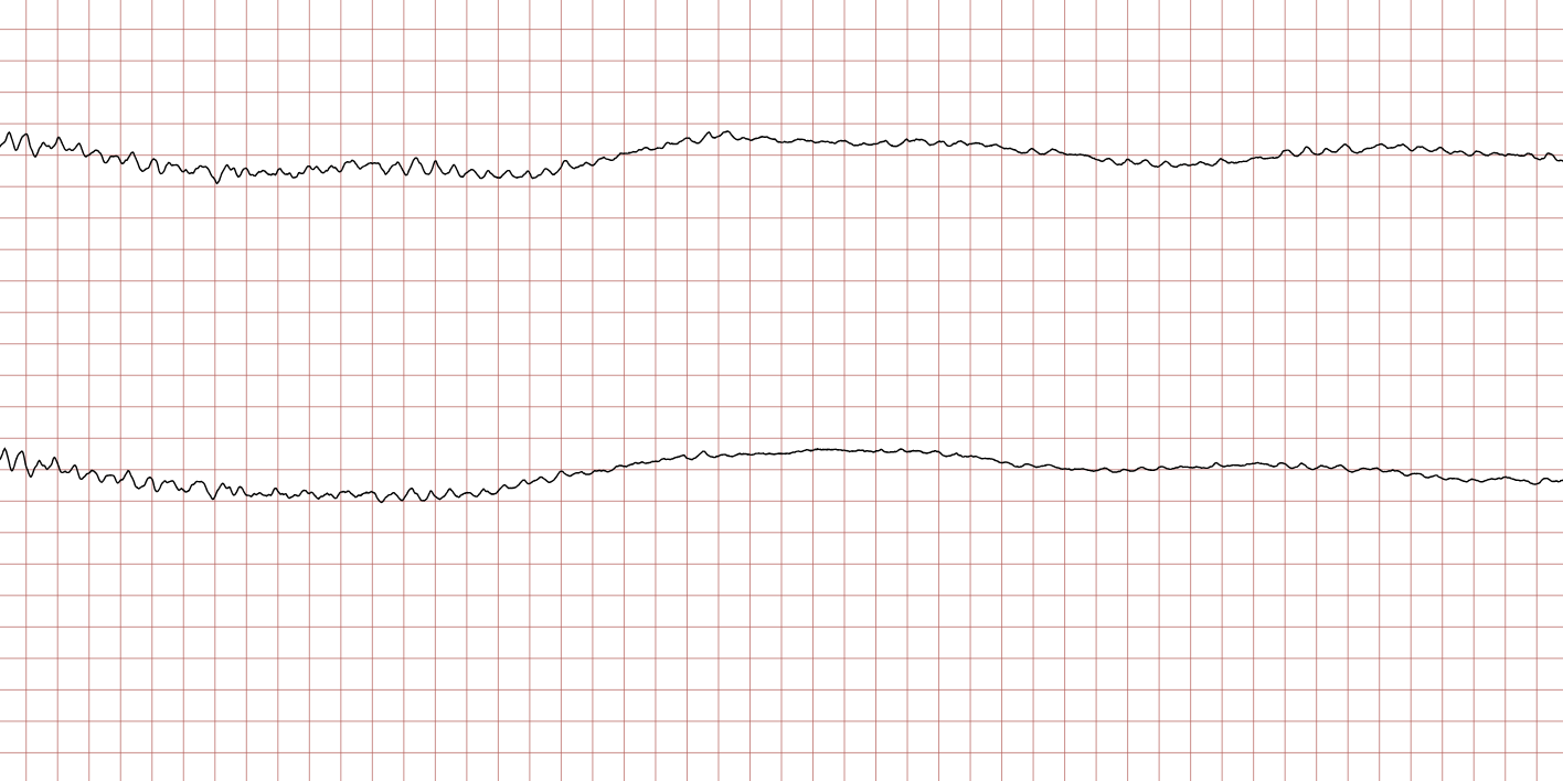 EKG 5 (Fall 2): feines Kammerflimmern mit niedrigen Amplituden, leicht mit Asystolie zu verwechseln