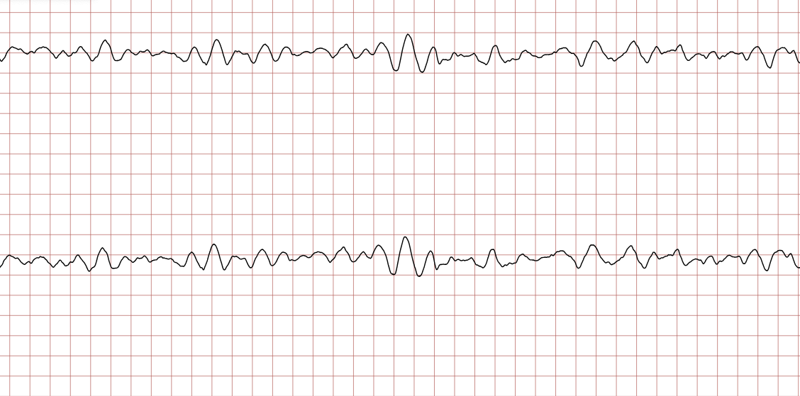 EKG 7 (Fall 2): grobes Kammerflimmern