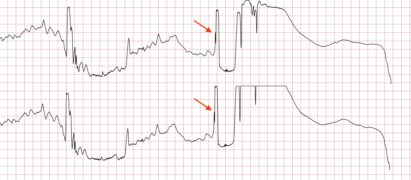 EKG 9 (Fall 2): Schockartefakt, markiert mit rotem Pfeil, danach flache Linie im Sinne einer Asystolie
