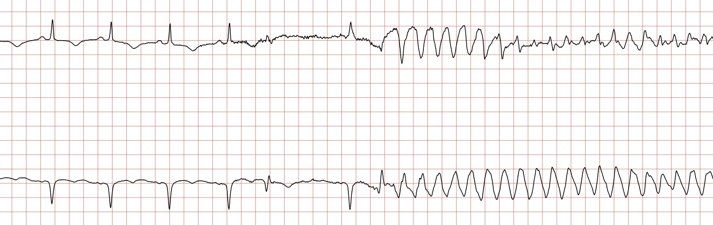 EKG 1 (Fall 3): zwei Kanäle mit Sinusrhythmus, der von einer ventrikulären Tachykardie mit breiten Komplexen unterbrochen wird