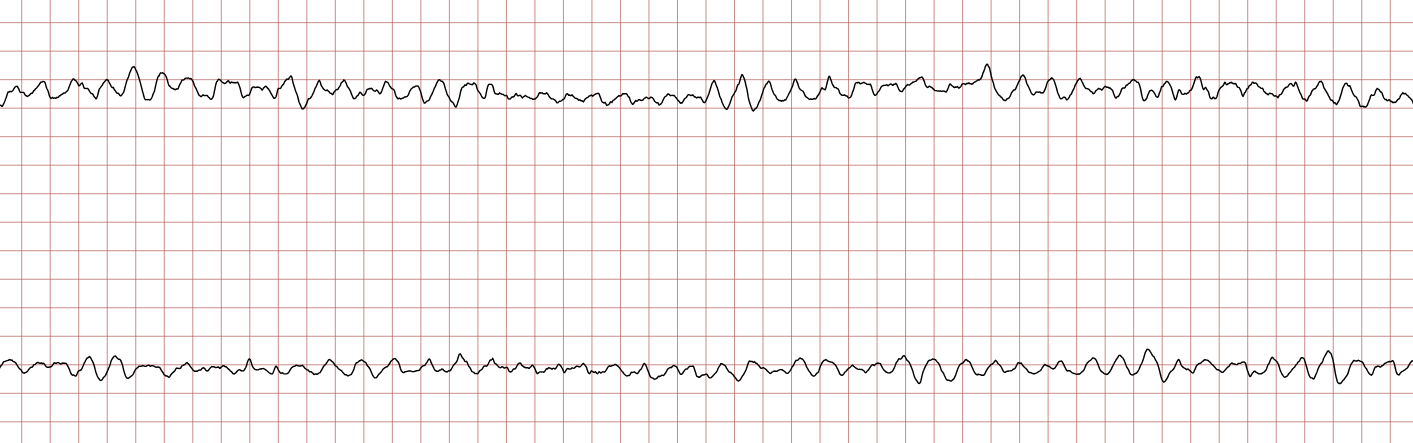 EKG 4 (Fall 3): fortbestehendes Kammerflimmern