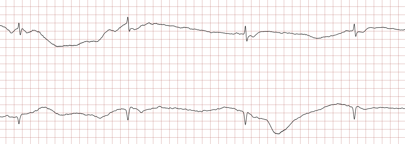 EKG 9 (Fall 3): fortbestehender supraventrikulärer Rhythmus
