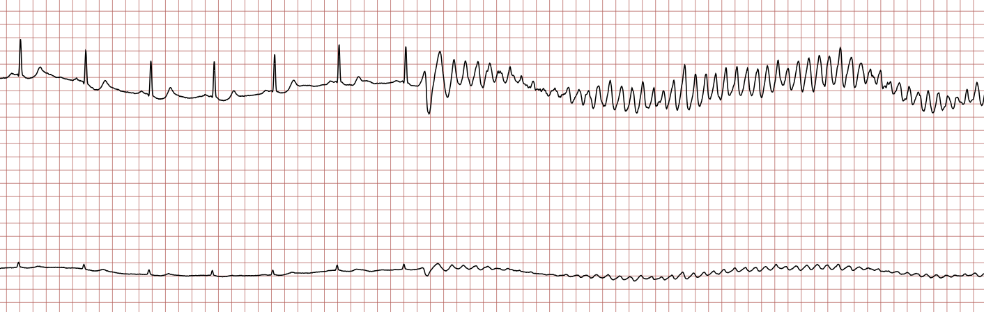 EKG 1 (Fall 5): Sinusrhythmus, unterbrochen durch eine polymorphe ventrikuläre Tachykardie mit wechselnder QRS-Form