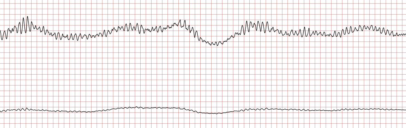 EKG 2 (Fall 5): polymorphe ventrikuläre Tachykardie mit wechselnder Morphologie und Amplitude der Komplexe