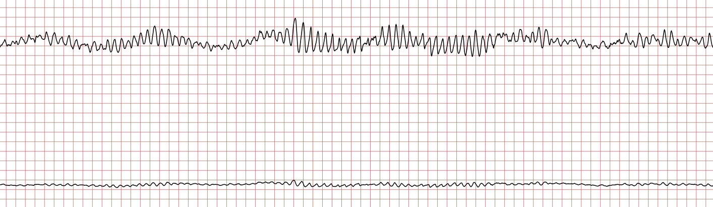 EKG 3 (Fall 5): die polymorphe ventrikuläre Tachykardie geht in Kammerflimmern über