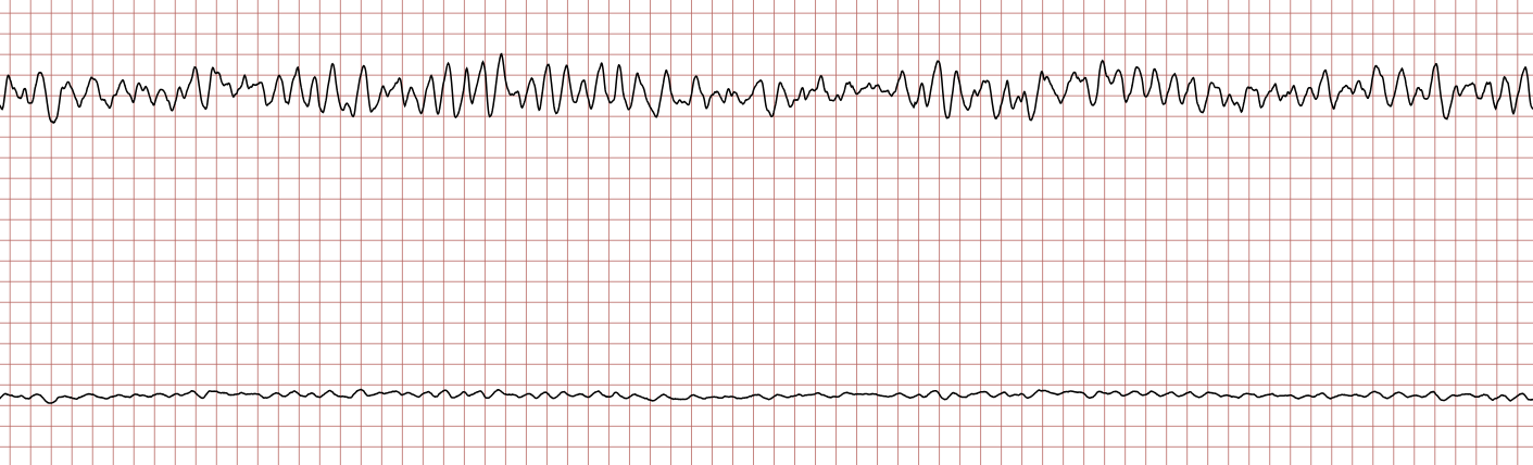 EKG 5 (Fall 5): Kammerflimmern ohne abgrenzbare QRS-Komplexe
