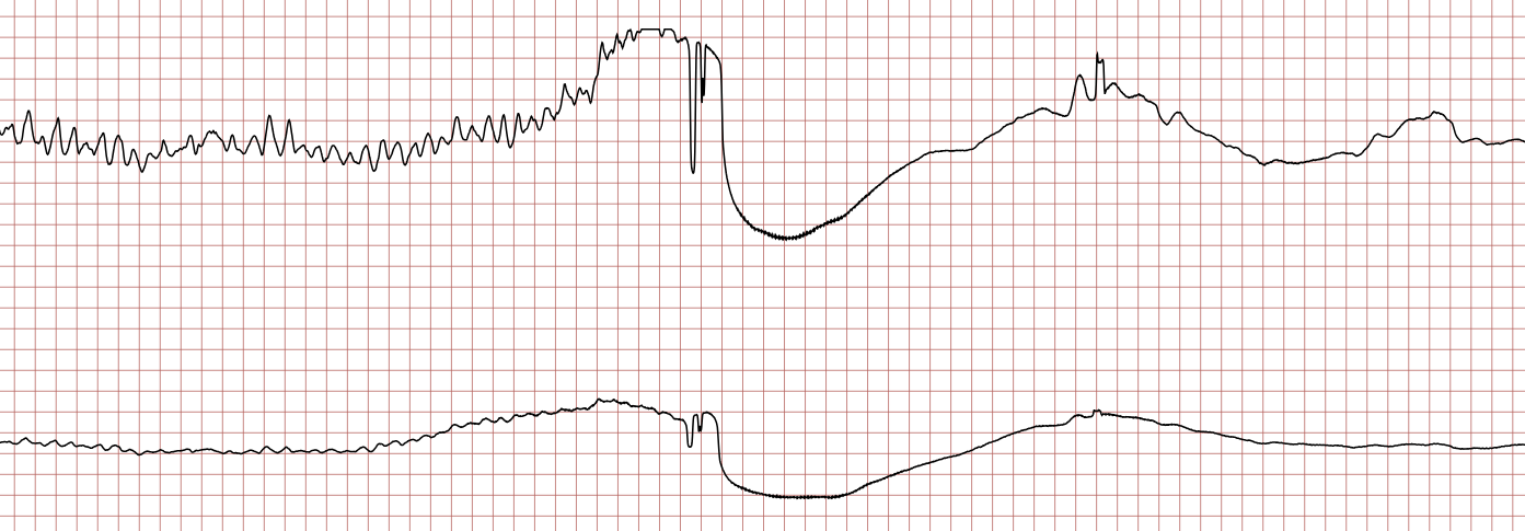 EKG 6 (Fall 5): Schockartefakt während Kammerflimmern