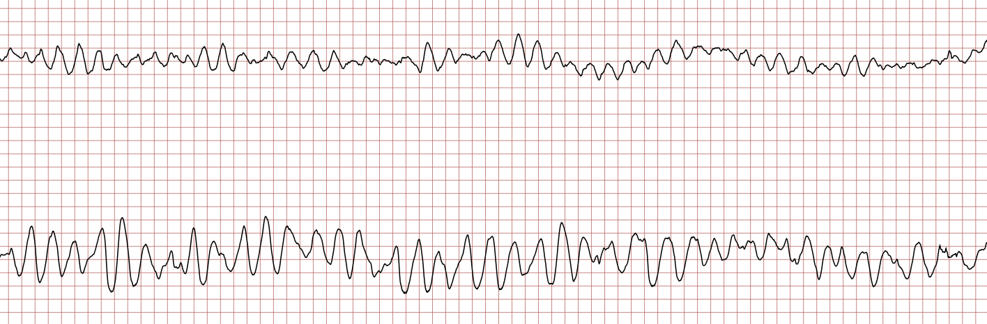EKG 4 (Fall 6): weiterhin polymorphe ventrikuläre Tachykardie oder Kammerflattern
