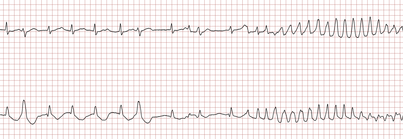EKG 1 (Fall 7): zwei Kanäle mit Vorhofflimmern, unterbrochen durch eine polymorphe ventrikuläre Tachykardie