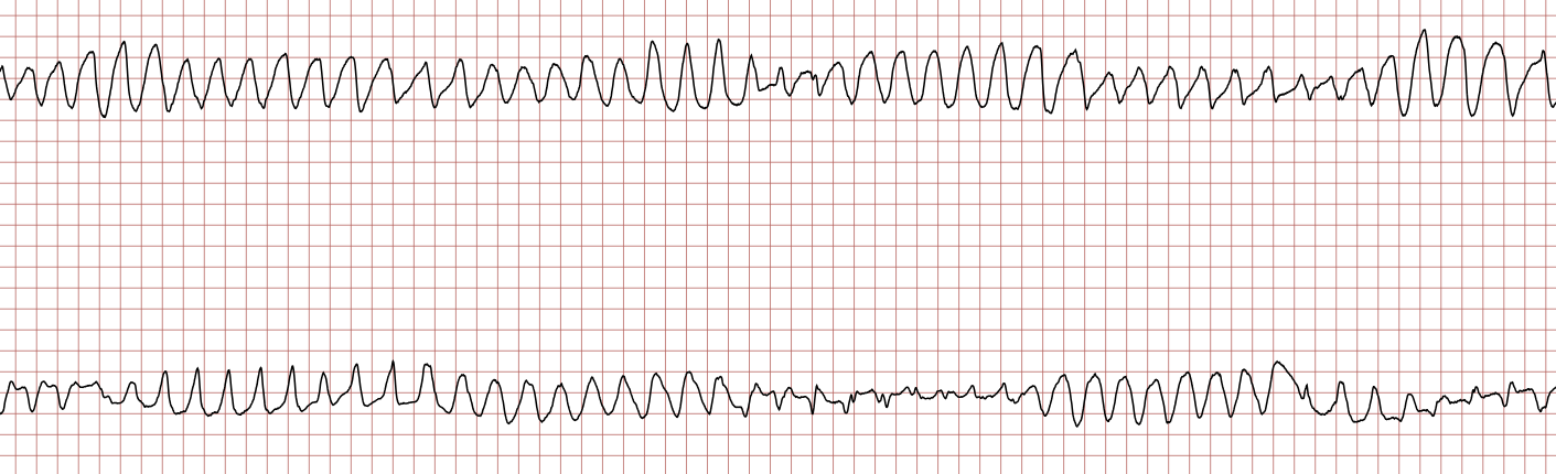 EKG 2 (Fall 7): polymorphe ventrikuläre Tachykardie mit wechselnder Form der Komplexe