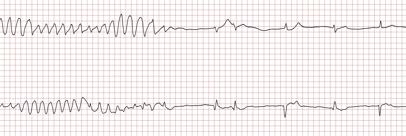 EKG 3 (Fall 7): die ventrikuläre Tachykardie endet spontan
