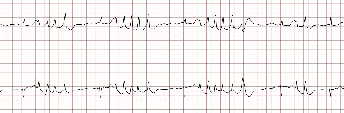 EKG 6 (Fall 7): wiederholte Salven einer ventrikulären Tachykardie