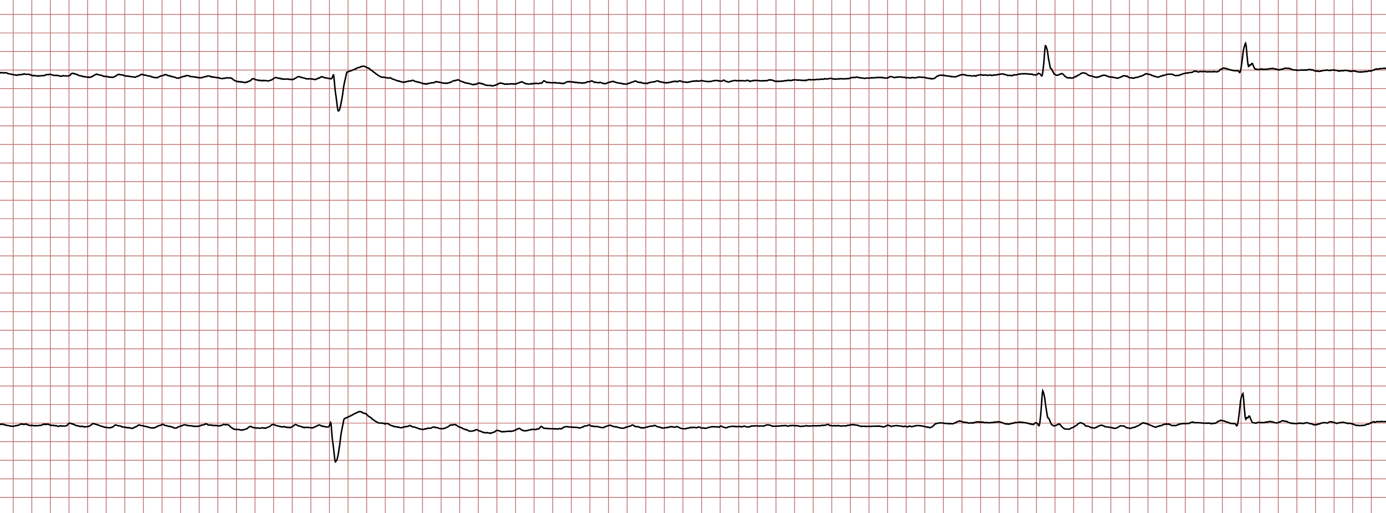 EKG 1 (Fall 8): Vorhofflimmern mit drei QRS-T-Komplexen, die letzten beiden mit ähnlicher QRS-Morphologie