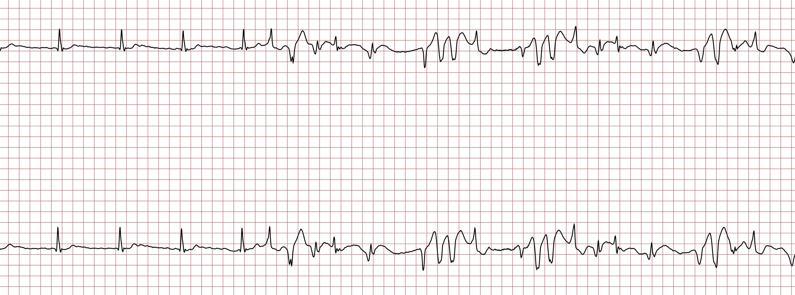EKG 2 (Fall 8): zunächst QRS-Komplexe wie in EKG 1, vermutlich supraventrikulär, danach drei kurze Salven einer ventrikulären Tachykardie