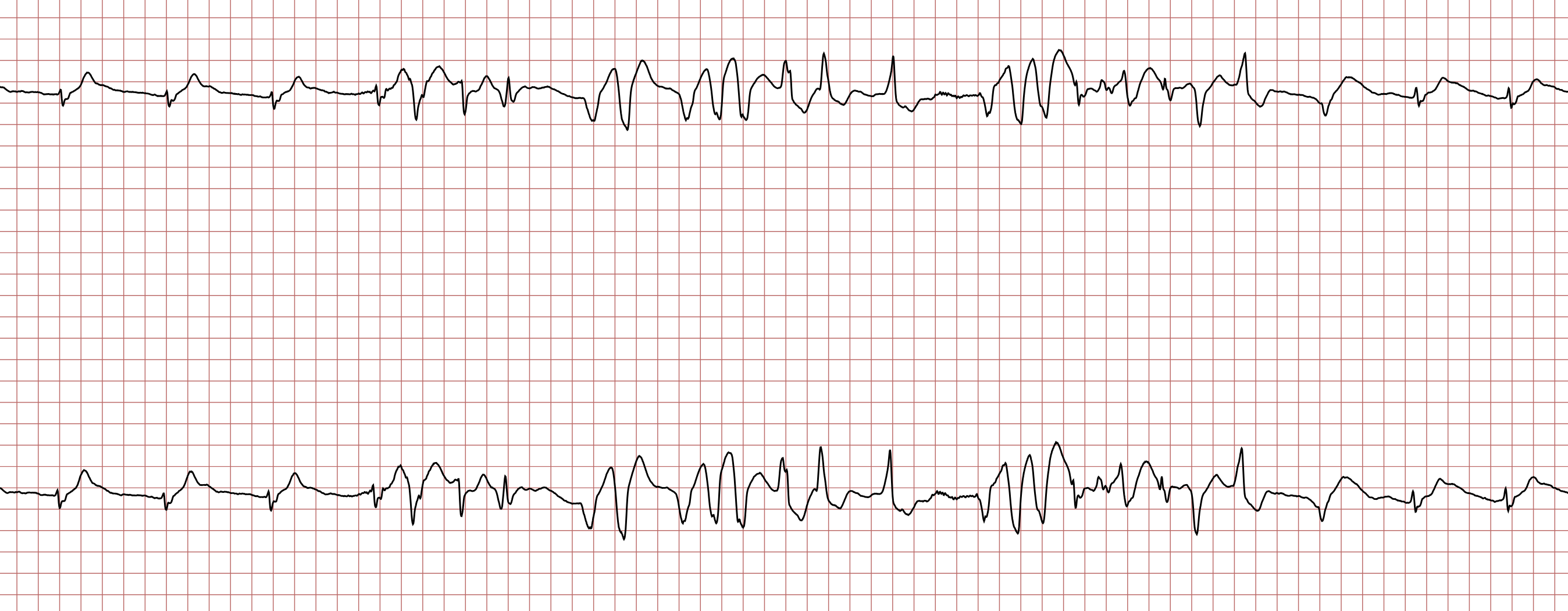 EKG 3 (Fall 8): wiederholte Salven einer ventrikulären Tachykardie