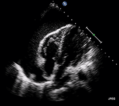 Echokardiographische Darstellung eines Pendelherzens (swinging heart) in einem großen Perikarderguss mit Herzbeuteltamponade
